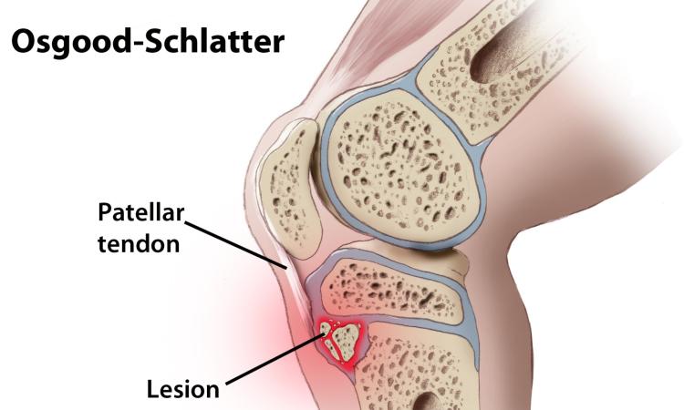 La sindrome di Osgood-Schlatter, l'approfondimento a cura della Fisio Eur Gennari